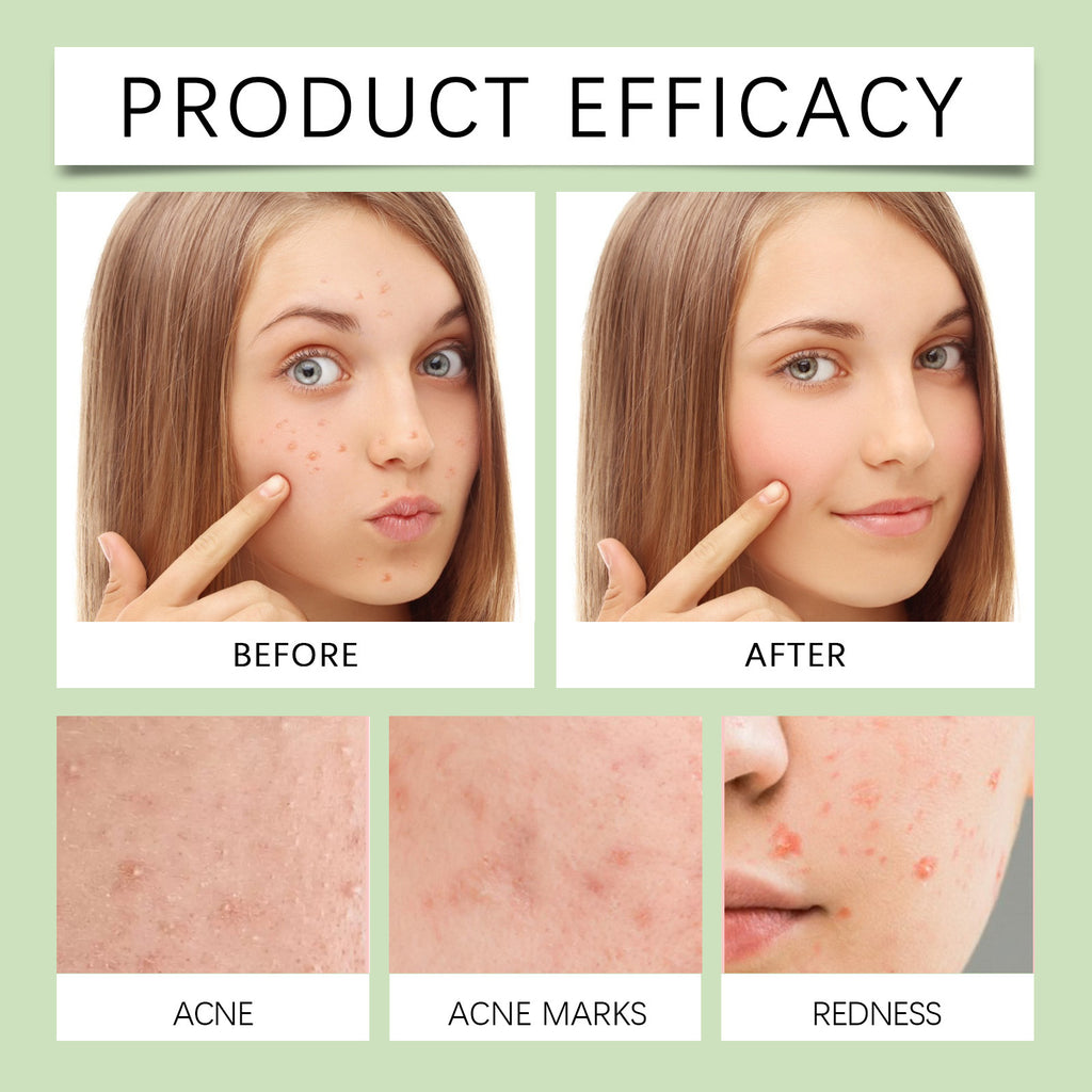 Acne Miracle Patch Removes Pimples Skin Care