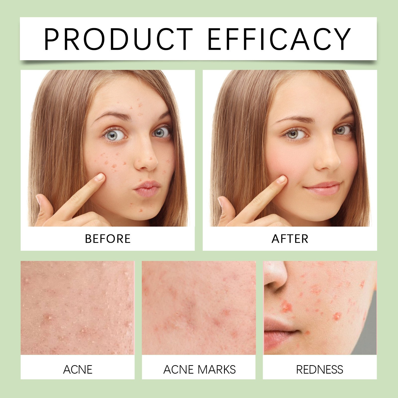 Acne  Patch Removal 